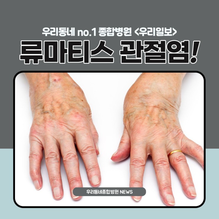 손가락의 저림 및 통증이 발생한다면  류마티스 관절염을 의심해보세요