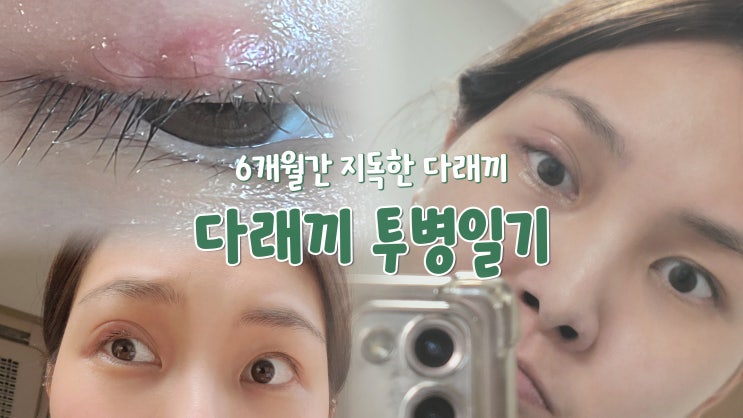 6개월 넘게 지독한 다래끼 인생의 암흑기 6개월 넘게 지독한 다래끼 인생의 암흑기