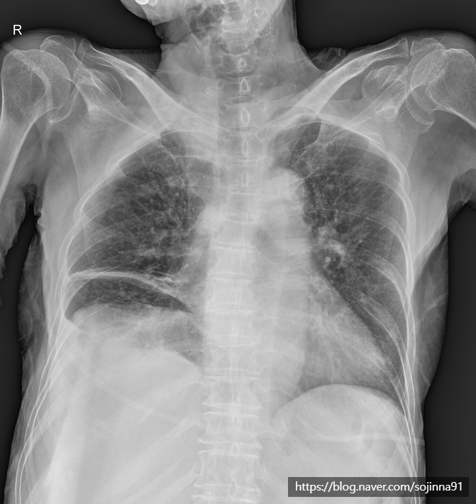 pleural effusion, 흉수 : chest x-ray에서 흉수 양 체크와 마취 시 유의사항. 진단적 흉수 천자는 언제?