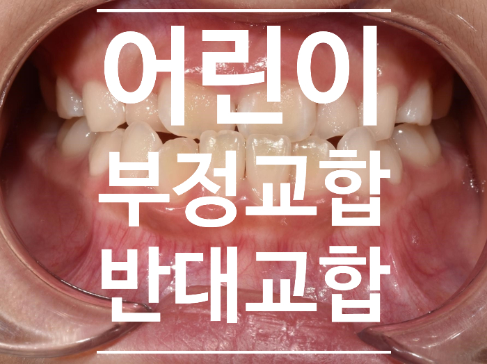 강일동 상일동 부정교합 아래턱 발달(주걱턱)을 교정 치료해야 한다면?