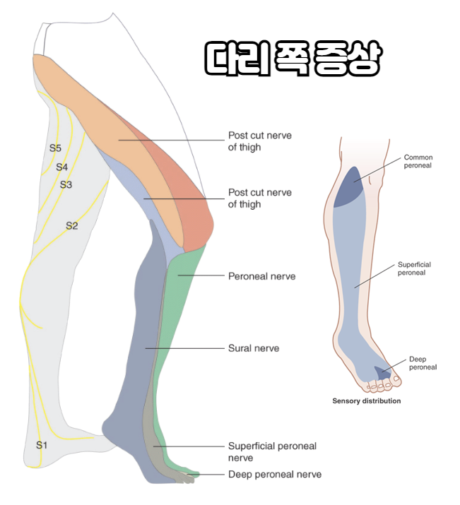 좌골신경통 증상 치료 및 이상근증후군 스트레칭 방법 : 네이버 블로그