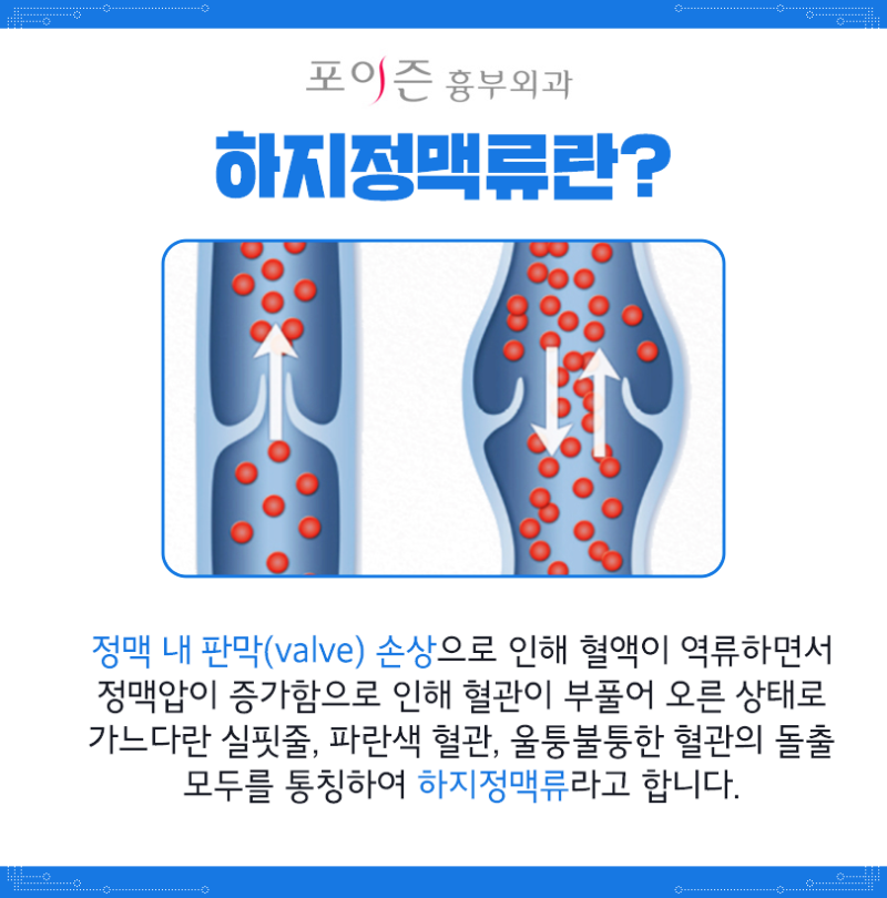 간단한 스트레칭으로 하지정맥류의 초기 증상을 관리하여 예방합니다. 9