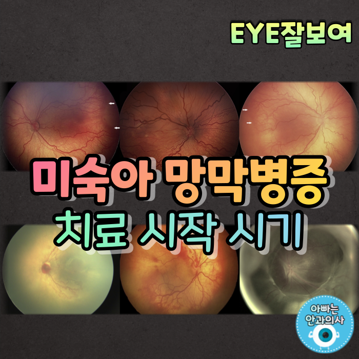 [EYE잘보여] 미숙아 망막병증 (3) - 치료 시작 시기