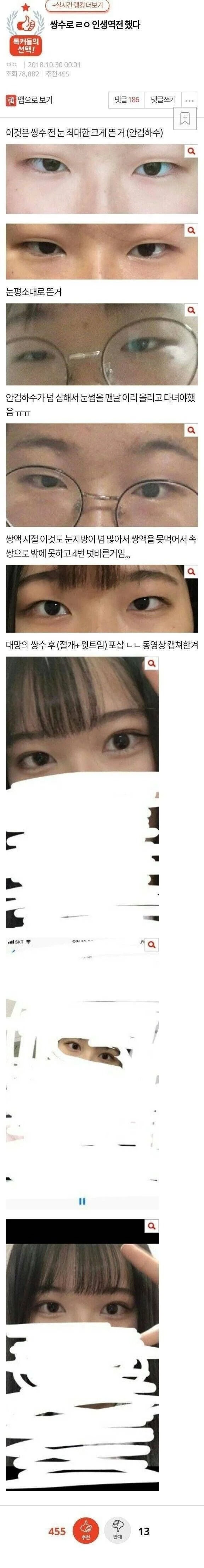 쌍수로 인생역전 했다 쌍수로 인생역전 했다