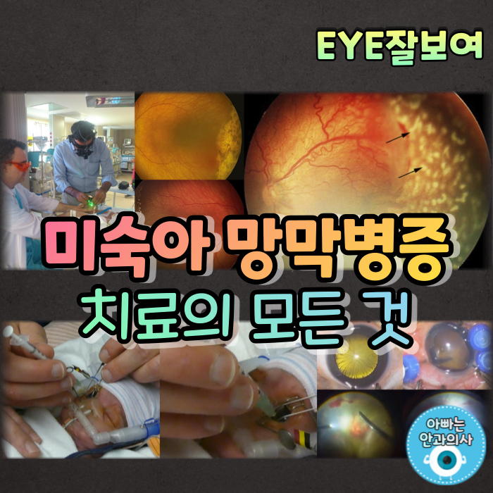 [EYE잘보여] 미숙아 망막병증 (4) - 치료방법과 예후
