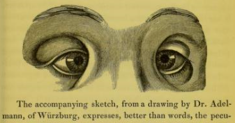  peculiar ethnic characteristics( in Epicanthus article)