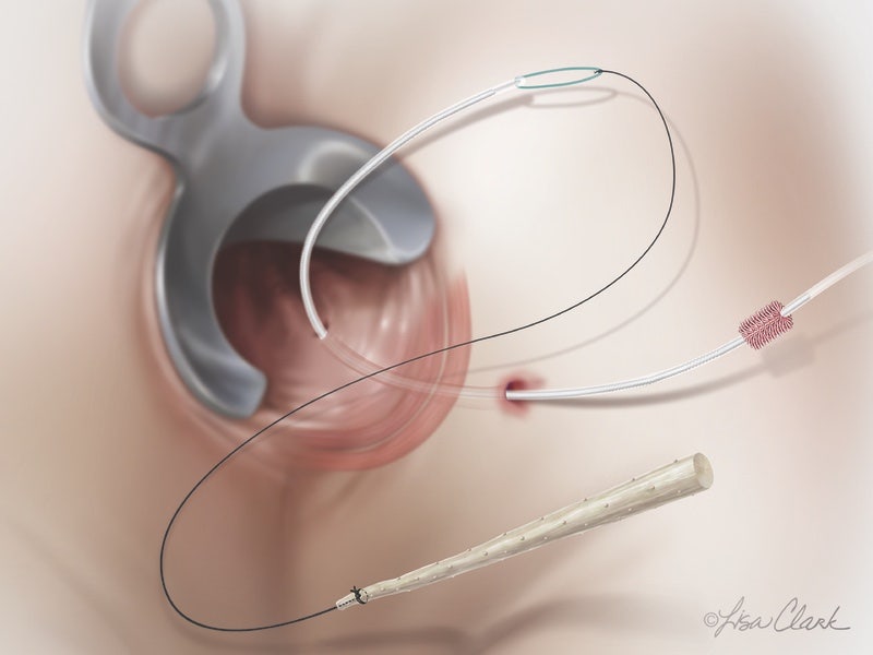 엉덩이 종기가 아니라 치료법이다...수원항문성형외과