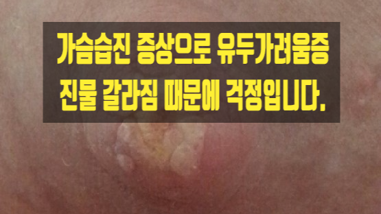  가슴습진 증상으로 유두가려움증 진물 갈라짐 때문에 걱정입니다.