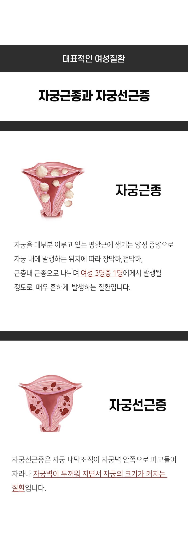 부천부인과 - 자궁근종 증상, 검사방법 등 모든 것