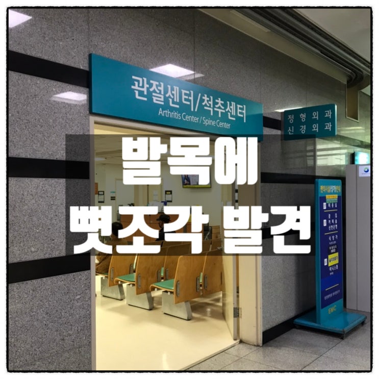 수술후유증 발목통증 대학병원 정형외과 엑스레이 검사결과 발목 관절사이에 뼛조각 발견 수술후유증 발목통증 대학병원 정형외과 엑스레이 검사결과 발목 관절사이에 뼛조각 발견