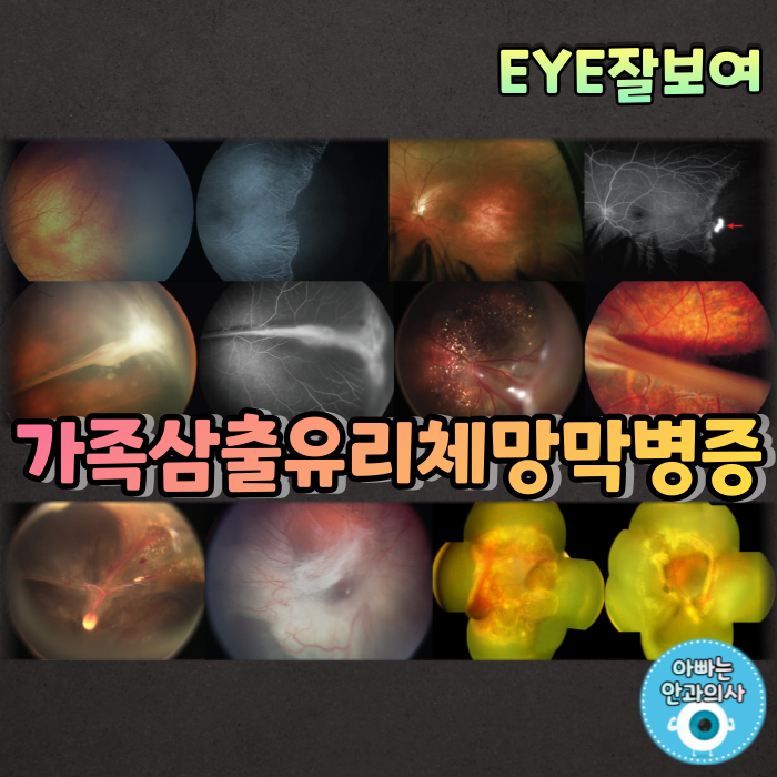  [EYE잘보여] 가족삼출유리체망막병증(Familial Exudative VitreoRetinopathy; FEVR)