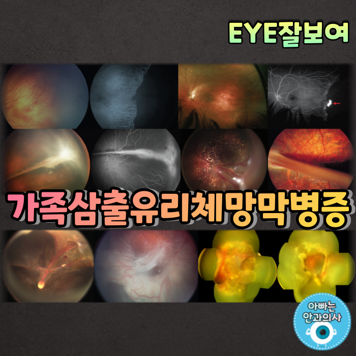 [EYE잘보여] 가족삼출유리체망막병증(Familial Exudative VitreoRetinopathy; FEVR)