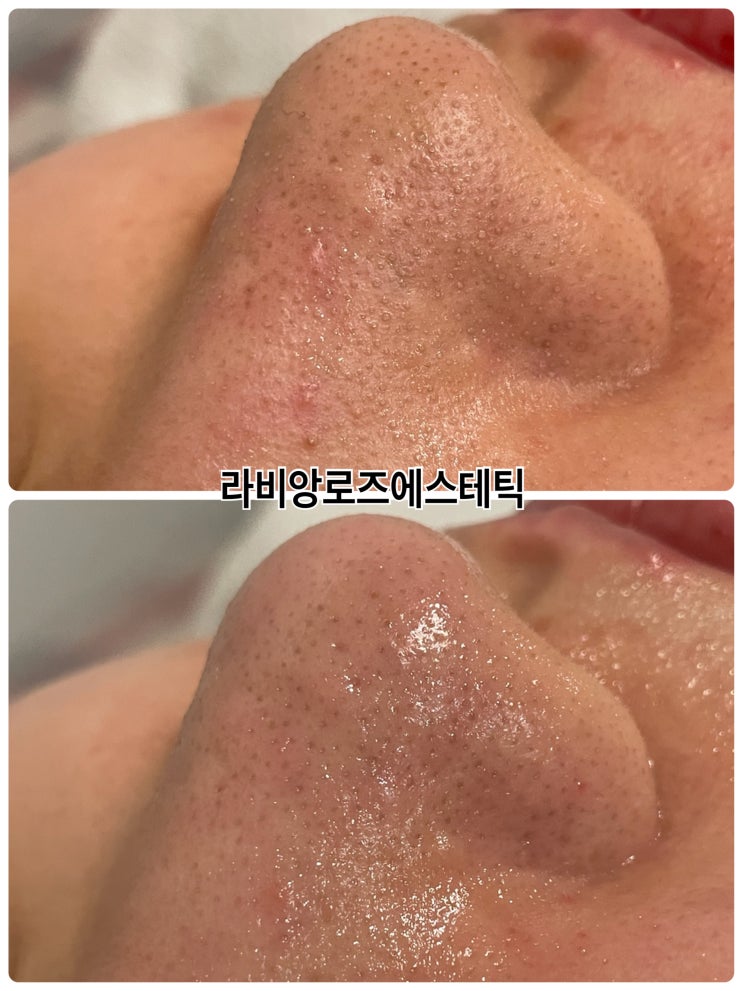  코피지제거기 아쿠아필효과 베리나이스~!