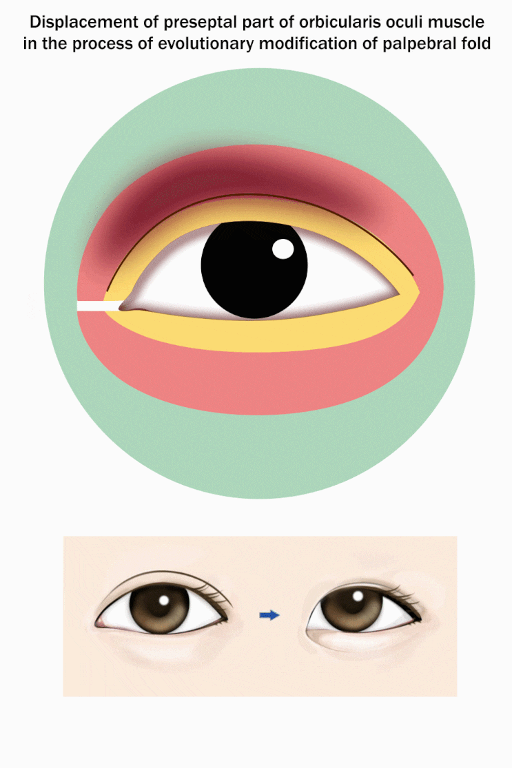  8. Denial of Epicanthus hypothesis(as a congenital anomaly) 몽고주름 가설의 부인