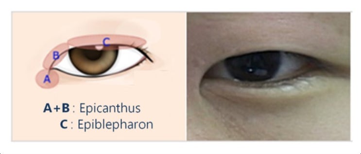  10. Epistemology of Epicanthus and Epiblepharon resulting in Epicanthoplasty and Blepharoplasty