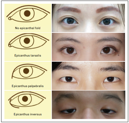 9. The classification of the epicanthus : relationship between epicanthus  and palpebral fold : 네이버 블로그