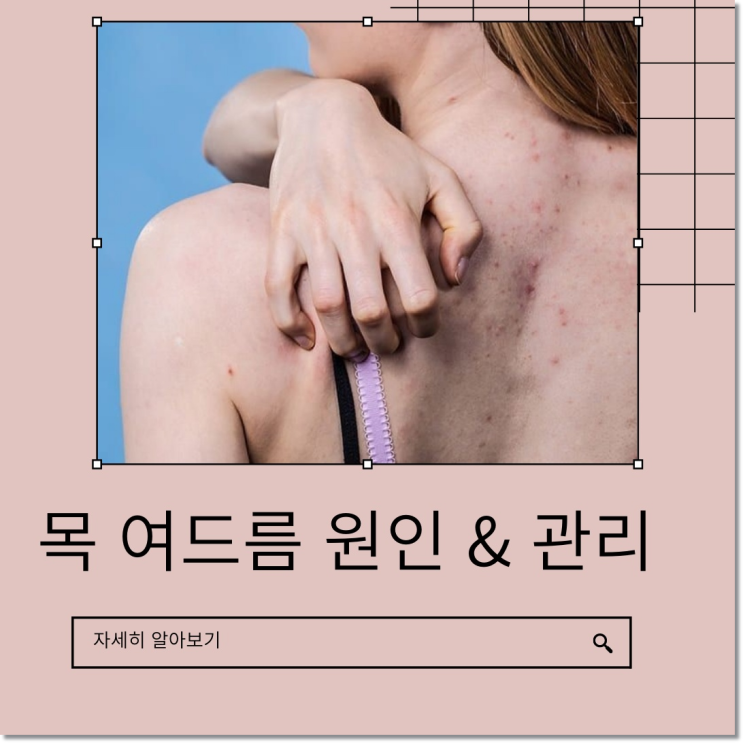 목 여드름 원인 사방팔방 목뒤 몸여드름 관리 하기 목 여드름 원인 사방팔방 목뒤 몸여드름 관리 하기