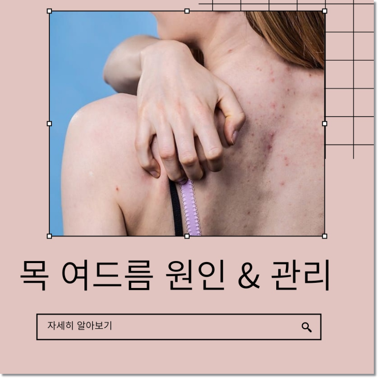 목 여드름 원인 사방팔방 목뒤 몸여드름 관리 하기