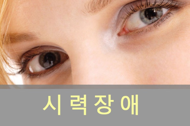  시력(난시/근시/원시) 장애 원인과 증상, 회복/좋아지는 법