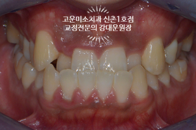  [주걱턱+반대교합] 제 3급 부정교합-성인