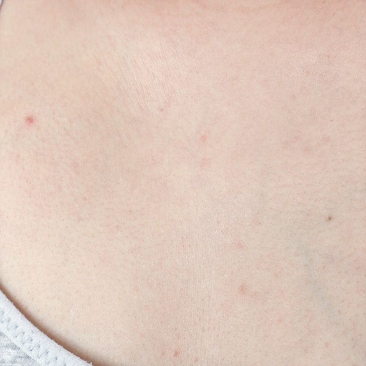 가드름 가슴 뾰루지 여드름 원인 흉터 케어방법 가드름 가슴 뾰루지 여드름 원인 흉터 케어방법