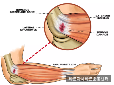  [서래마을PT]팔꿈치엘보,테니스엘보우(Tennis Elbow)