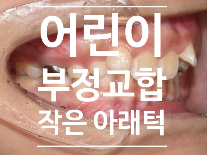 하남 작은 아래턱 부정교합 치료, 성장을 이용한 어린이 교정