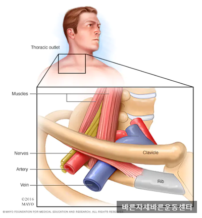  [서래마을PT] 손저림,손가락저림,흉곽출구 증후군(TOS:Thoracic outlet syndrome)