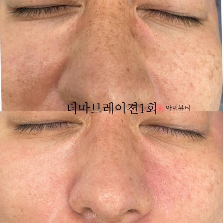  대구아미뷰티 모공축소 블랙헤드 쌓인각질 더마브레이젼으로 해결하세요 런칭기념50%할인 1:1  수강