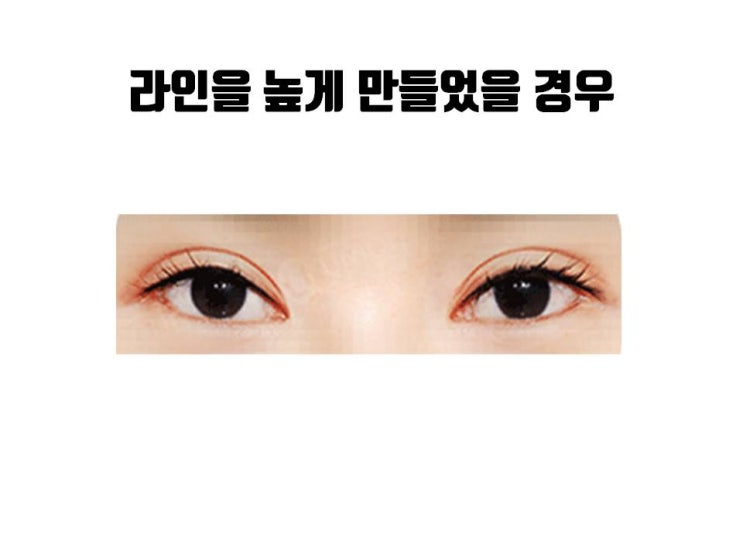  쌍꺼풀 수술 방법 선택을 잘 하면 쌍수 붓기 기간도 줄일 수 있어요!!!
