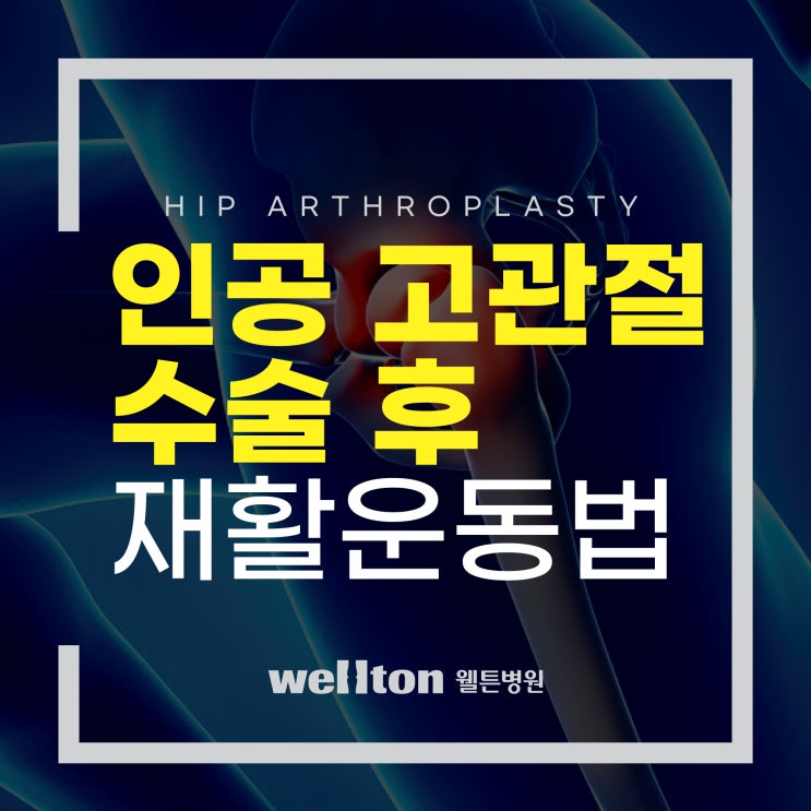  인공고관절수술 후 재활운동법