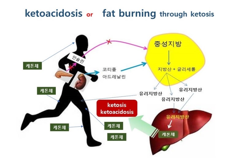  케톤생성식사(ketogenic diet), 케톤혈증(ketosis)과 케톤산증(ketoacidosis):연재 2편