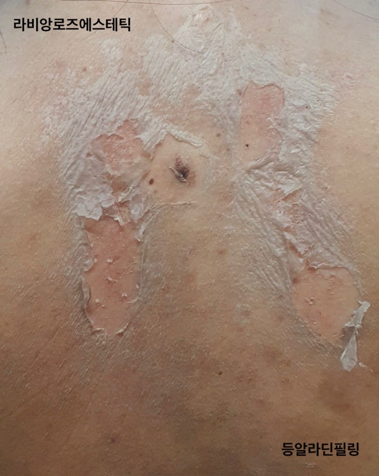  회기 알라딘필링 잘하는 곳 [라비앙로즈에스테틱]