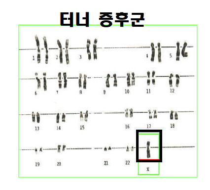  여성에게 발생하는 터너증후군 원인과 증상