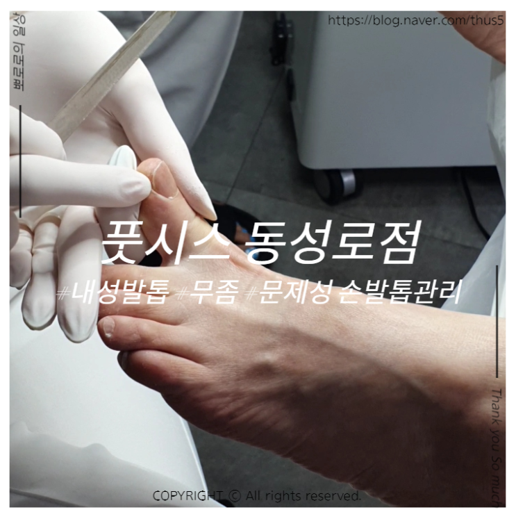  대구 내성발톱, 풋시스 동성로점 - 제대로 아는 곳에서 발 관리받자