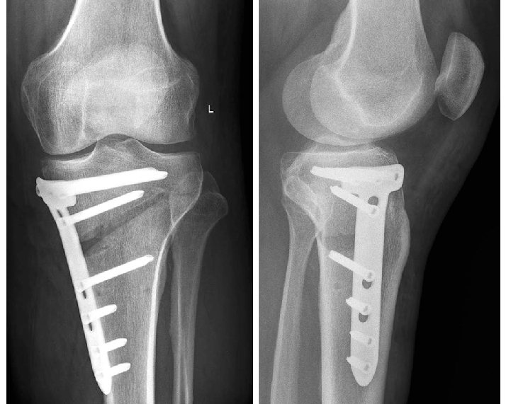 Корригирующая остеотомия большеберцовой кости. Биос остеосинтез большеберцовой кости. Околосуставная остеотомия коленного сустава. Корригирующая остеотомия коленного.