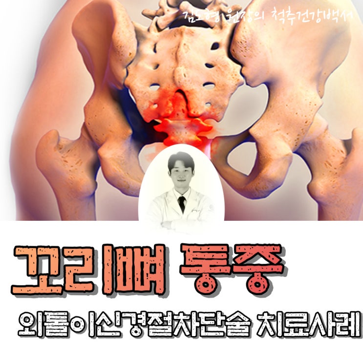  꼬리뼈 통증, 외톨이신경절차단술 치료 사례