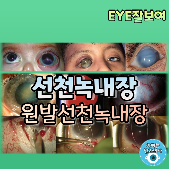 [EYE잘보여] 선천성 녹내장