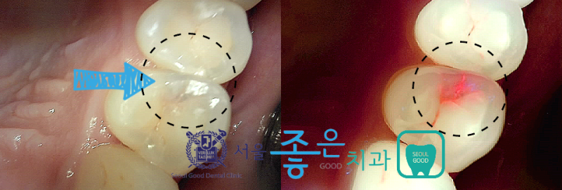 보험 충치치료 태평역치과 서울좋은치과 – 초기 충치는 모두 치료해야 할까요? 7