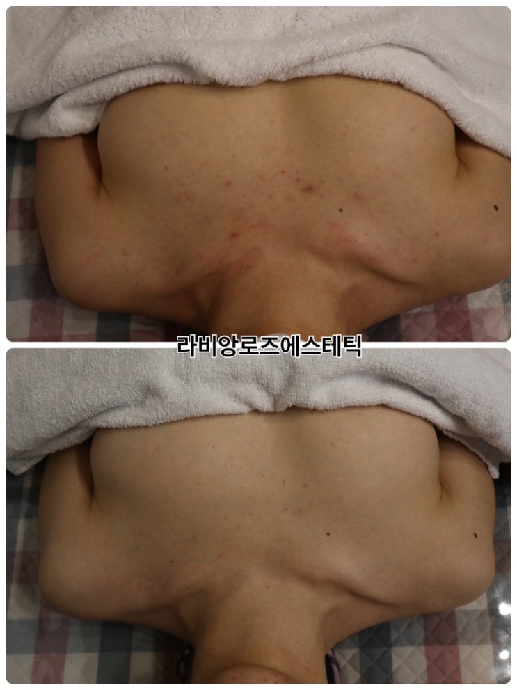  청량리 피부관리 알라딘필링으로 등드름 가드름 원인, 해결방법