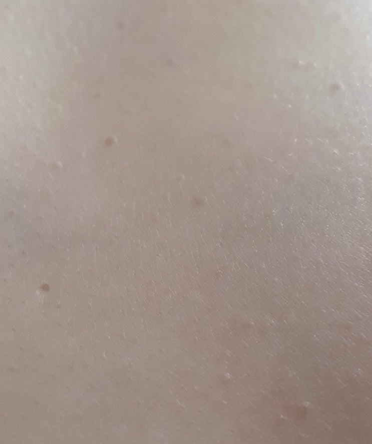  온 몸 편평사마귀 제거 후기 1탄(얼굴&목1차/CO2레이저)