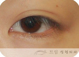  동양인의 쌍꺼풀주름(Palpebral fold)은 출생 시부터 존재하는 경우 외에도 다양한 생애주기 동안 발현되는 경우가 있다.  .....말단방사섬유 흔적기관