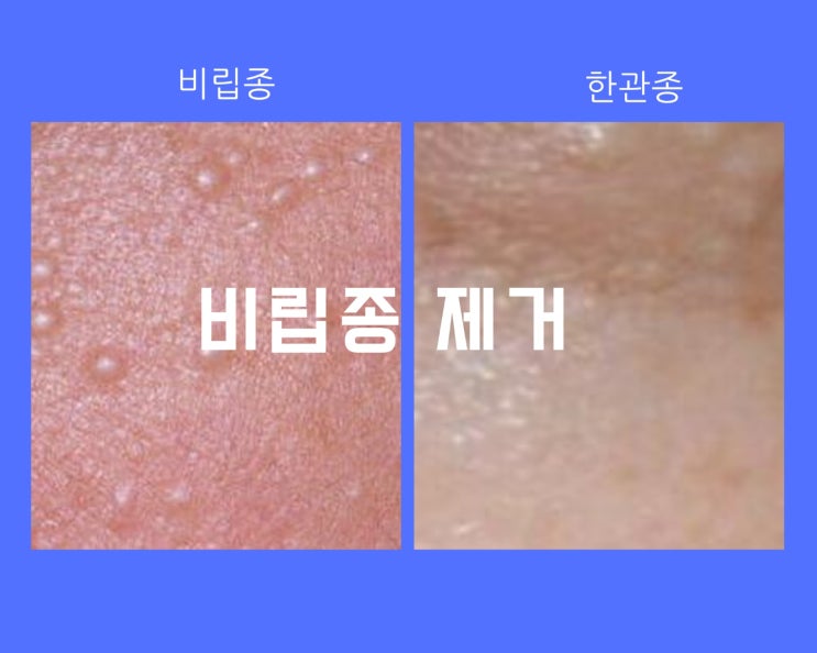 눈 눈가 얼굴 비립종 현명하게 제거 하기