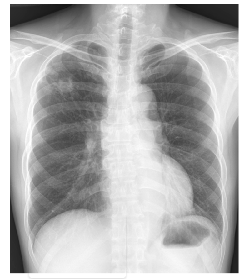 활동성 폐결핵 폐엑스레이 x-ray 증례, 증상, 특징 소견 : 네이버 블로그