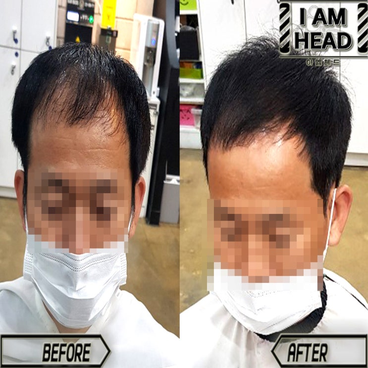  남자M자탈모커버펌 단점커버 링거펌