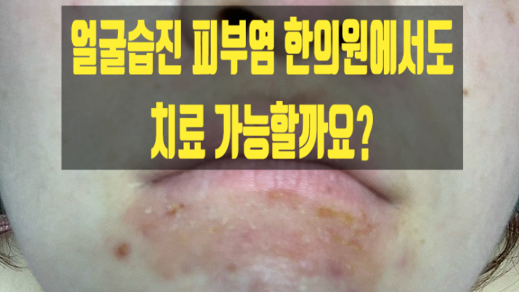 얼굴습진 피부염 한의원에서도 치료 가능할까요?