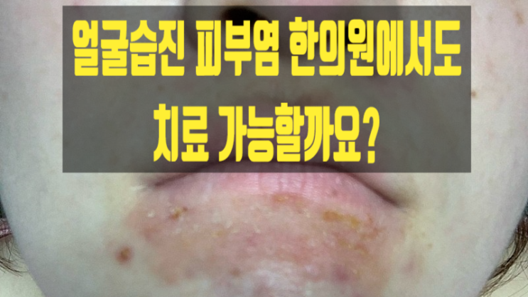  얼굴습진 피부염 한의원에서도 치료 가능할까요?