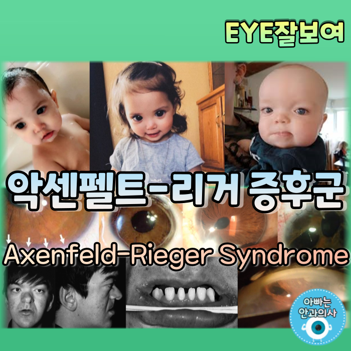 [EYE잘보여] 악센펠트-리거 증후군 (Axenfeld-Rieger Syndrome)