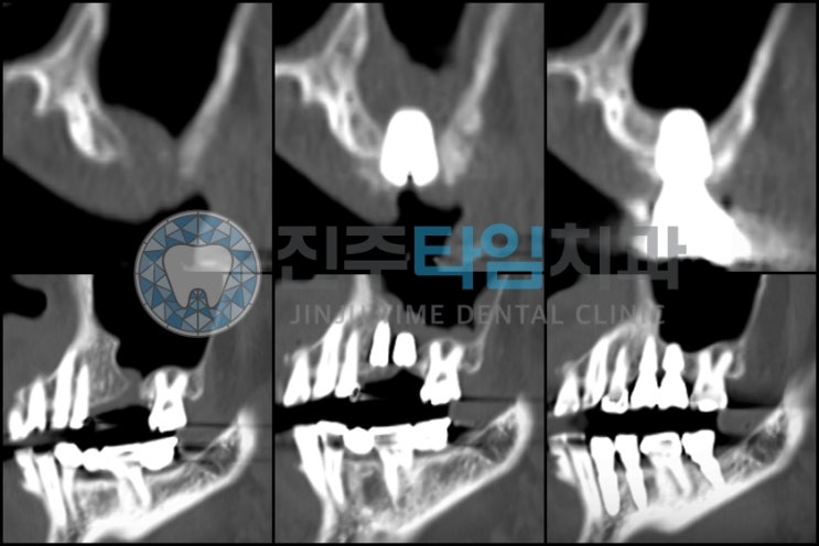  발치와 치유부전 후 임플란트 #구강-상악동누공 #oroantral fistula #오스템TSIV