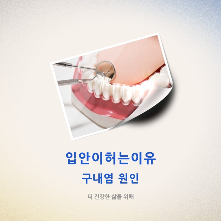  입안이허는이유 구내염 원인?!